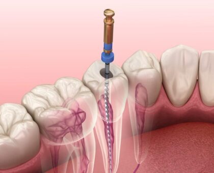 Root Canals