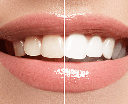 Whitening